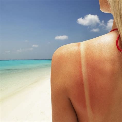 Itchy Sunburn How To Relieve Hells Itch Fast