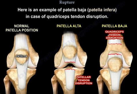 Quadriceps Tendon Rupture Orthopaedicprinciples Com