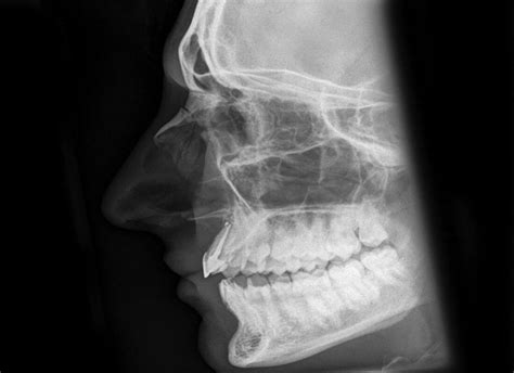 X Ray Nasal Bone Fracture After Stockfoto 1068960836