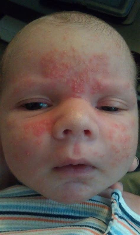 Bad Baby Acne Pics Experiences Babycenter