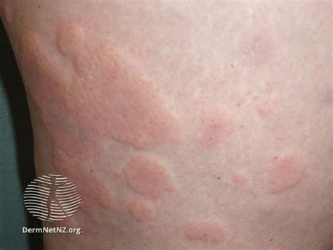 Allergy Rashes 3 Common Types And Pictures