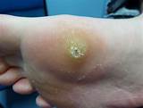 New Wart Treatment Images