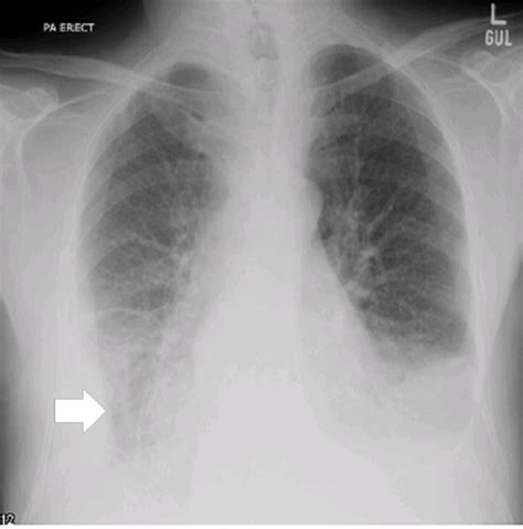 Chest X Ray Shows Scanty Bilateral Pleural Effusion And Focal Increased Images