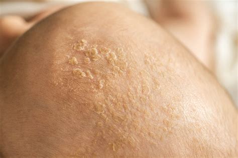 What You Need To Know About Seborrheic Dermatitis Rocketfacts