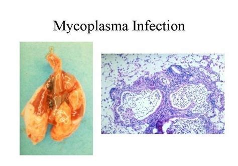 Mycoplasma Hominis Igm