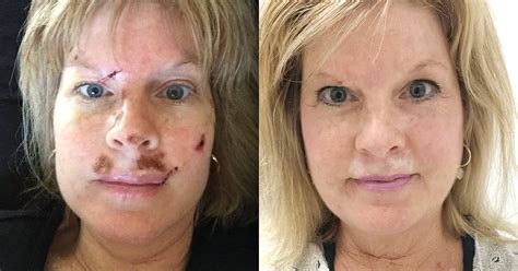 How To Prevent Skin Cancer Woman Has 40 Spots Removed Over 25 Years