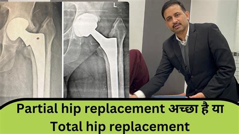 Partial Hip Replacement Vs Total Hip Replacement Which Is Better