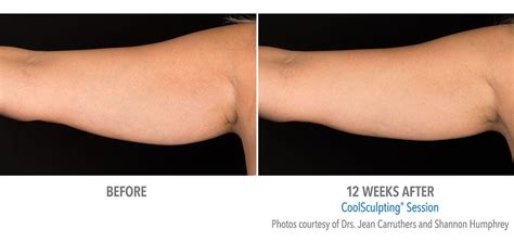 Coolsculpting In Nyc Manhattan And Queens Fat Freezing Treatments
