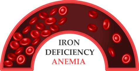 Causes And Management Of Iron Deficiency Anaemia Medicszone