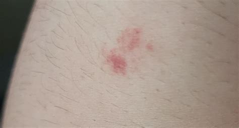 Getting Red Splotches Like This On My Arm And Leg Some Bigger Than