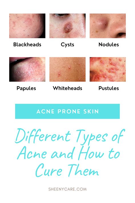 Different Types Of Acne And How To Treat Them In 2021 Different