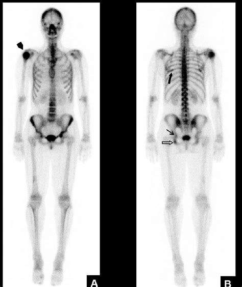 Anterior A And Posterior B Bone Scintigraphy Scan Of The Whole Body