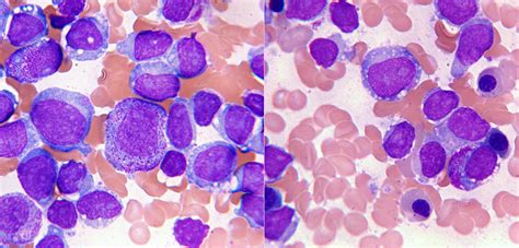 Case Report Of Granular Acute Lymphoblastic Leukemia And Review Of The