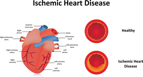 Ischaemic Heart Disease Pathogenesis Treatment