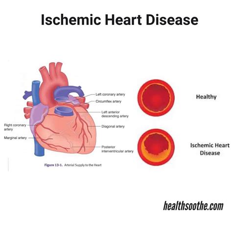 Ischemic Heart Disease Symptoms Causes Treatment And Prevention