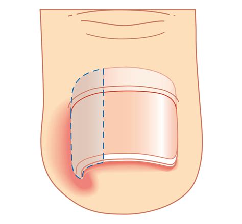 What Are The Beginning Stages Of An Ingrown Toenail Nagy Footcare