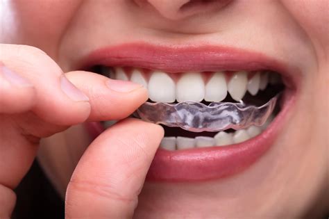 Benefits Of Clear Alignerinvisalign Treatment In Salem Or