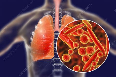 Pneumonia Caused By Mycoplasma Pneumoniae Bacteria Conceptu Stock