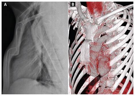 Stairlike Fracture Of The Sternum Cmaj