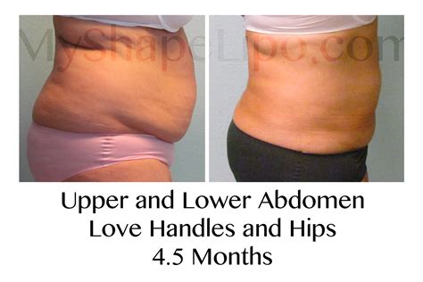 MyShape Lipo Announces Their Fight Against Obesity And Promotes Large