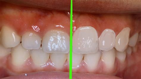How To Make Teeth Bigger Naturally Update New