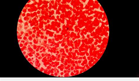 Gram Stain Examination 1000 X Showing Unevenly Stained Irregular