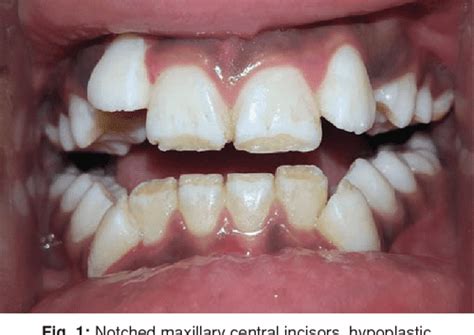 Figure 3 From Dental Manifestations Of Congenital Syphilis In A 12 Year