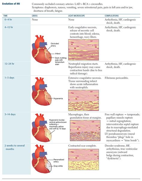 Stages Of Myocardial Infarction Speights Stages Of Myocardial Images