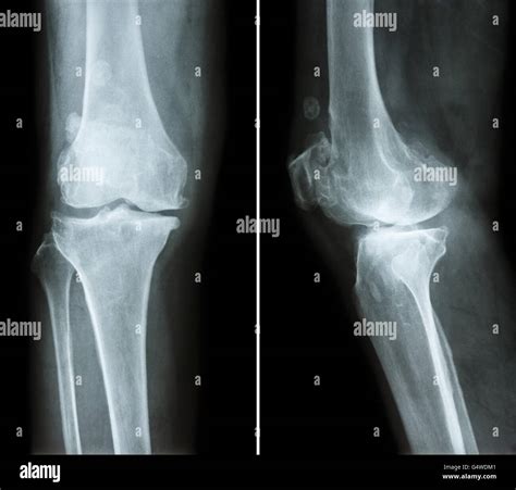 Osteoarthritis Knee Film X Ray Knee Anterior Posterior And