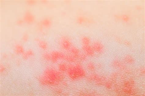 5 Things You Need To Know About Heat Rash Livestrongcom
