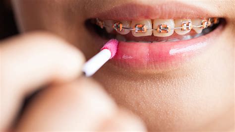 Braces Colors What Colors Are Available And How To Choose