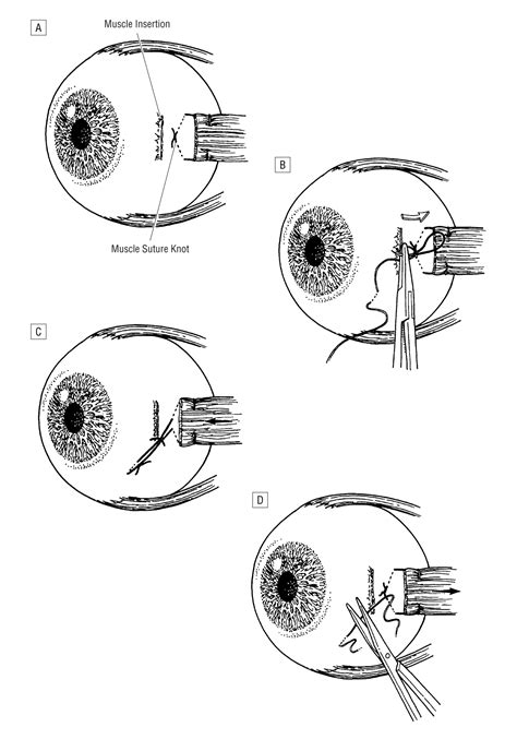 Ripcord Adjustable Suture Technique For Use In Strabismus Surgery