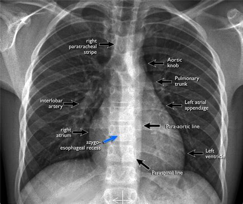 Pa View On The Pa Chest Film It Is Important To Examine Grepmed