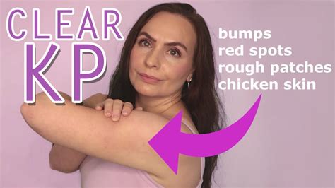Just Simple Steps Will Clear Kp Keratosis Pilaris Bumps Youtube