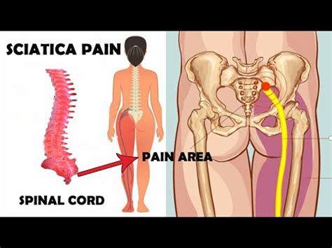 This is the newest place to search, delivering top results from across the web. Acupressure Point for Sciatica By Ratan Jangid - YouTube