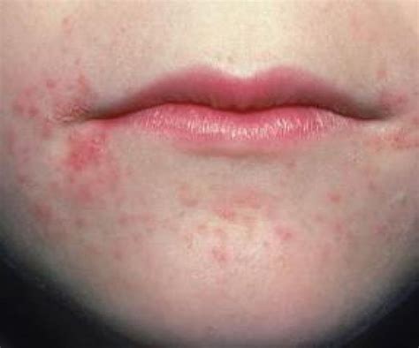 Сыпь вокруг рта и аллергические высыпания у взрослого