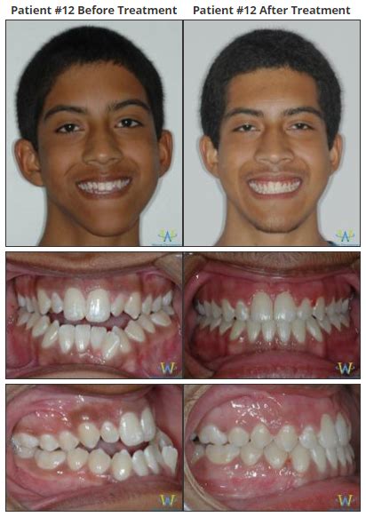Braces Before And Afters Walton Orthodontics