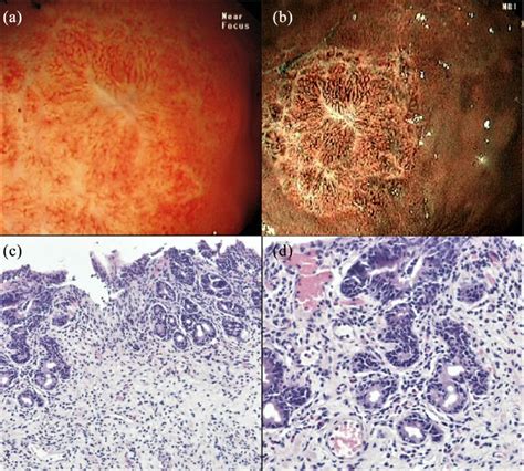 Esophagogastroduodenoscopy And Biopsies Of Case 1 A Erosions In The