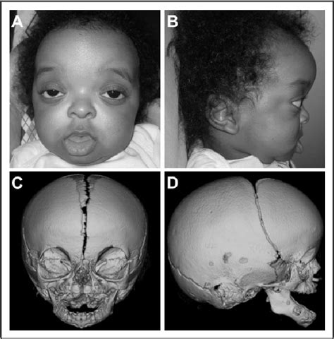 Crouzon Syndrome With Acanthosis Nigricans Disorder Semantic Scholar