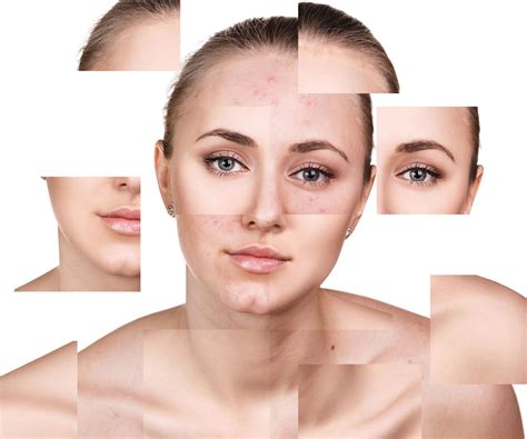 Certified Acne Care Clinic • Apeel Aesthetics