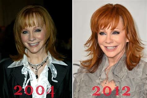 Reba Mcentire Plastic Surgery Before And After Photos Plastic Surgery Celebrity Plastic Surgery