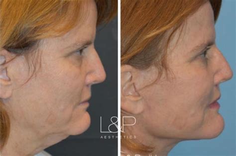 Facelift And Neck Lift Before And After Photos Case 29 Palo Alto And San