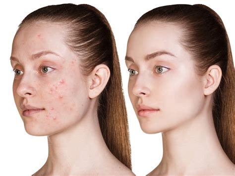 Planning To Go For An Acne Treatment