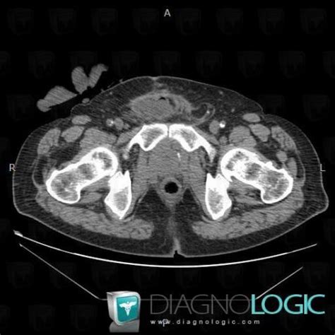 Cas Radiologie Hernie Inguinale Scanner Diagnologic