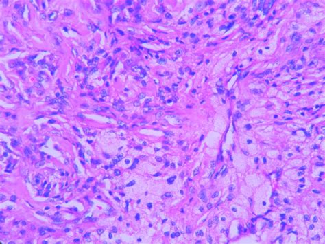 Giant Cell Tumor Of Tendon Sheath Histopathologyguru