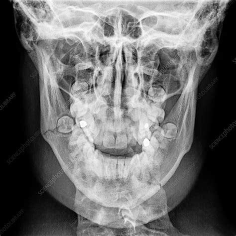Jaw Bone Fracture X Ray Stock Image C0382443 Science Photo Library