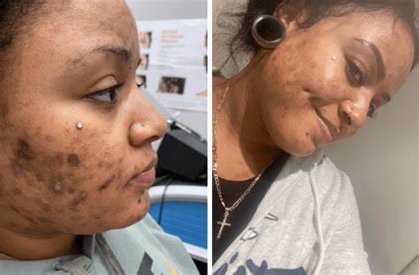 Picosure Acne Scar Removal Specialist El Segundo Ca La Skincare