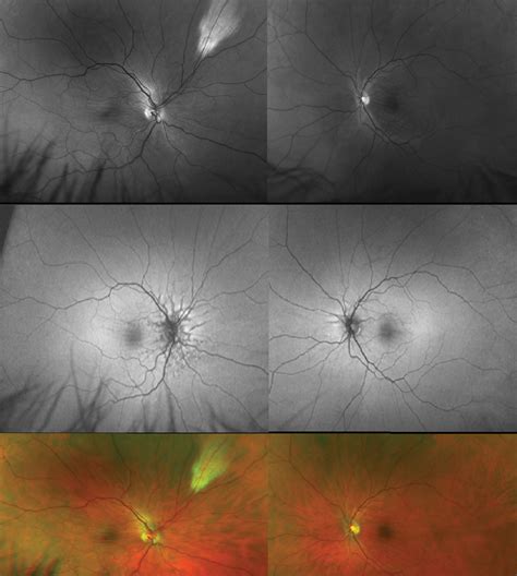 Lesson Choroidal Folds A New Wrinkle In Retinal Care