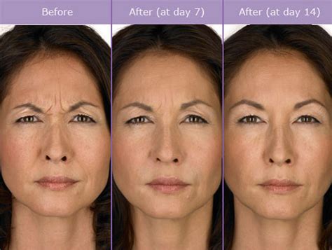 Botox Treatment Before And After Transform Me Med Spa