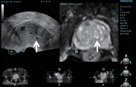 Ultrasound Journal 6 Improving Diagnostic Accuracy With Trusmri